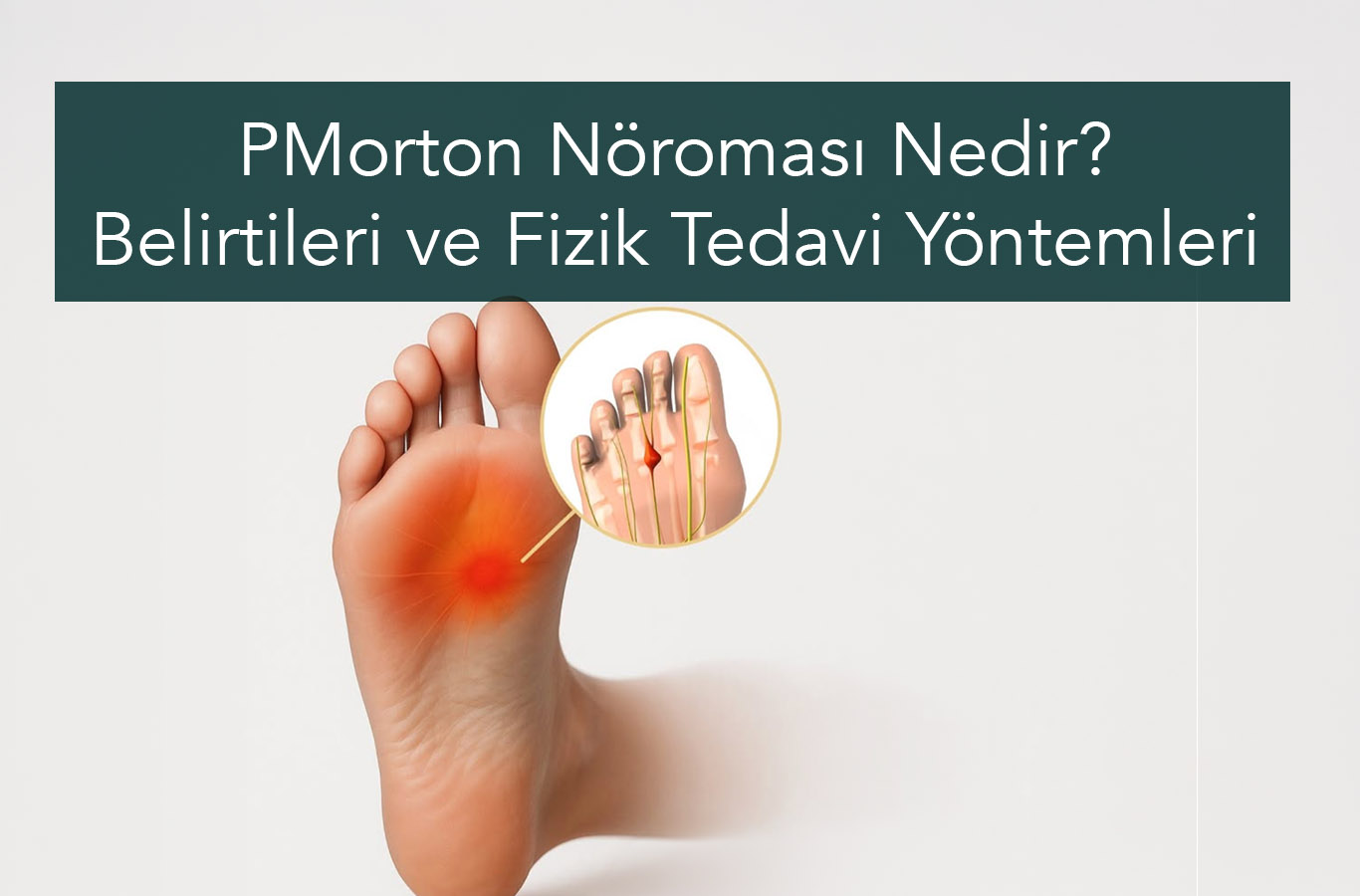Morton Nöroması Nedir? Belirtileri, Nedenleri ve Fizik Tedavi Yöntemleri